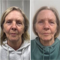 Genie Facelift Facial