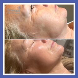 Genie facelift