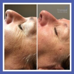 Skin Tightening - Radio Frequency