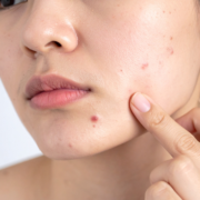 The Real Causes of Acne
