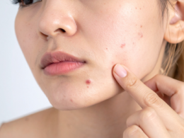 The Real Causes of Acne