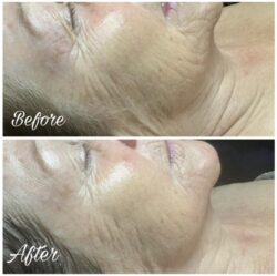 Brightening and Corrective Treatment - Before and After Pictures