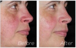 Rosacea and sensitive skin